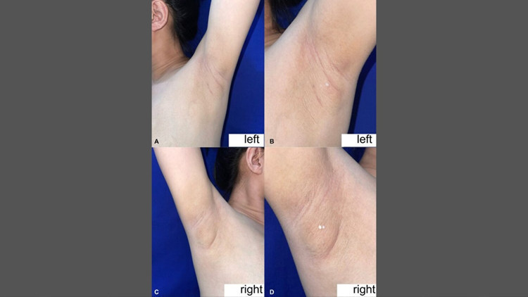 filipinli kadinin koltukaltindan sut geldi nadir gorulen durumun nedeni ne eNKhrxrv.jpg